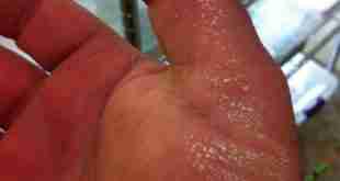 Oxidizing agent burned my skin when not wearing gloves.